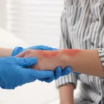 Regenerative Medicine Options Available for Burn Care