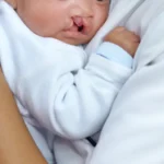 Understanding Cleft Lip and Palate: Diagnosis and Solutions